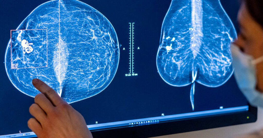 Expert Panel Reverses The Trend And Recommends Breast Cancer Screening