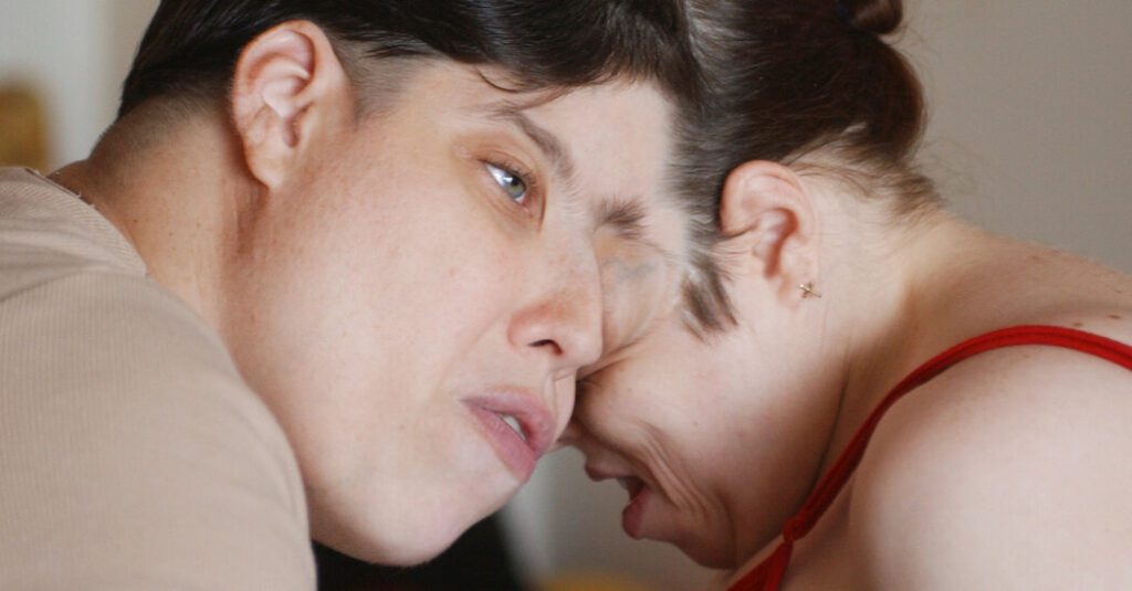 Long Lived Conjoined Twins Lori Chappelle And George Chappelle Die At
